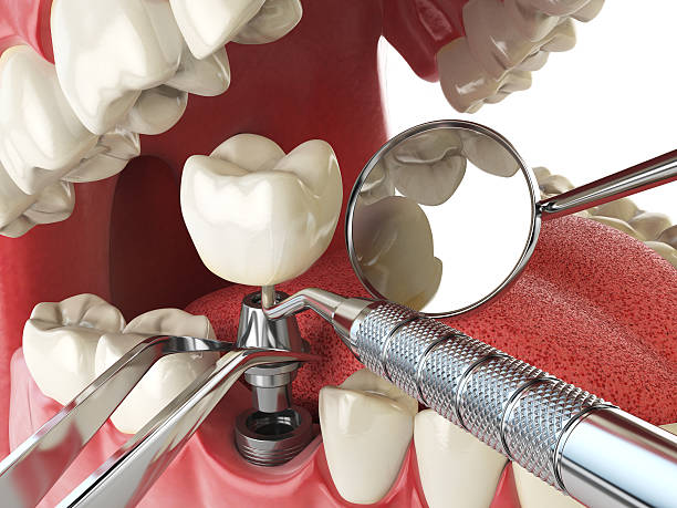 Best Dentist for Tooth Abscess  in China, TX