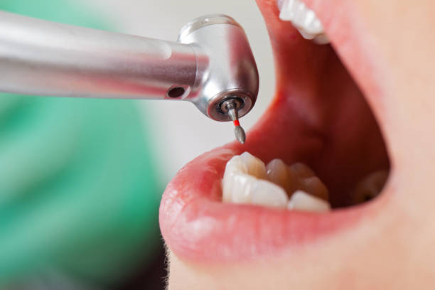 Best Dentist for Tooth Abscess  in China, TX